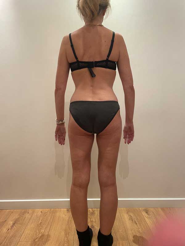 cure-amincissement-paris-avant-après-3