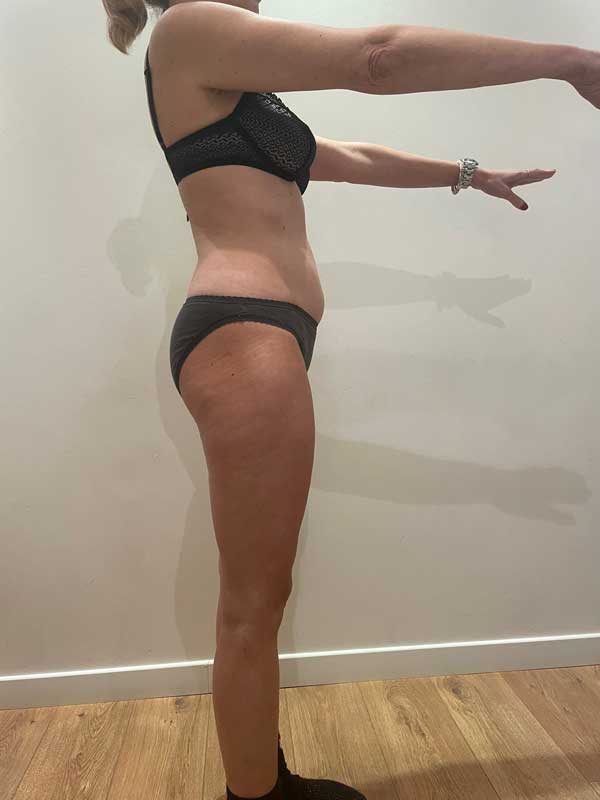 cure-amincissement-paris-avant-après-5