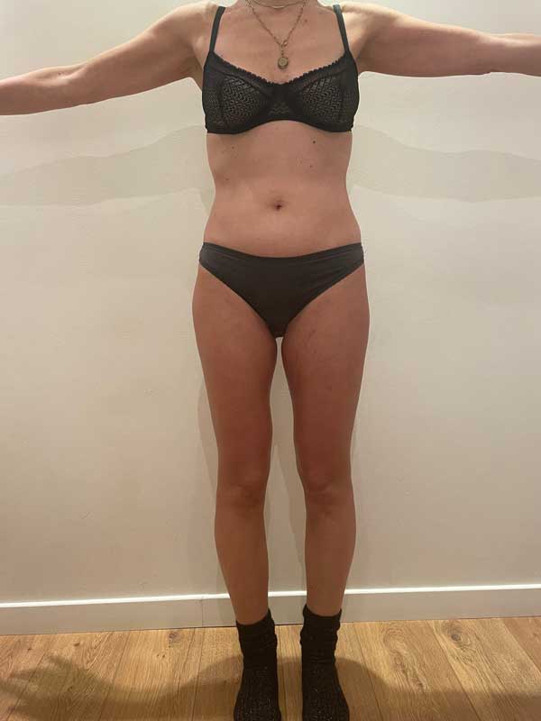 cure-amincissement-paris-avant-après